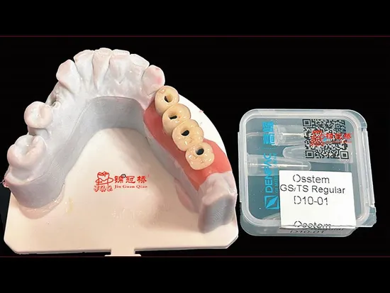 Plantas dentales personalizadas elaboradas con precisión y corte